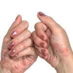 Impact of Psoriasis on Oral Health - Eleven Eleven Dental