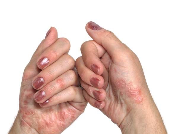 Impact of Psoriasis on Oral Health