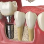 Dental Implants - Top 5 Reasons - Anatomy of healthy teeth and tooth dental implant in human dentura. 3d illustration