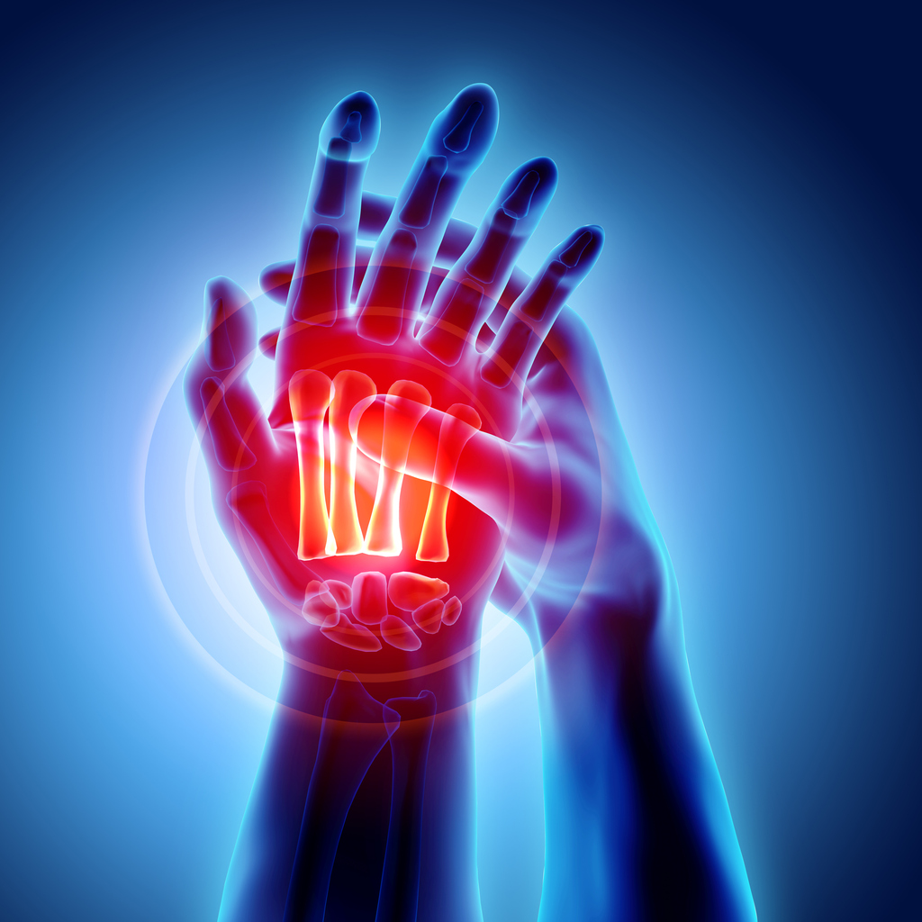Autoimmune Series: Rheumatoid Arthritis and Oral Health - 3D illustration of Palm painful