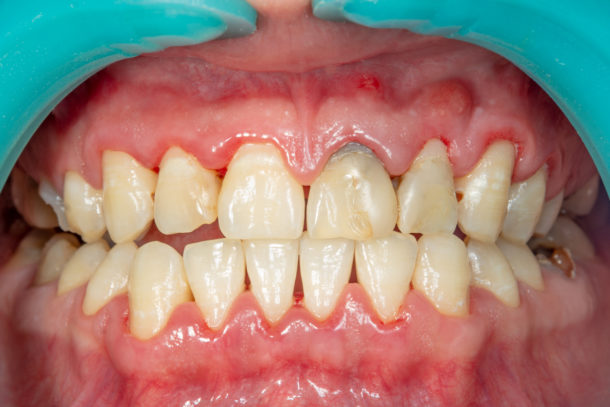 Periodontal Disease