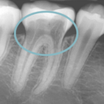 Tooth Resorption