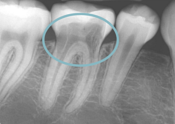 external resorption of tooth